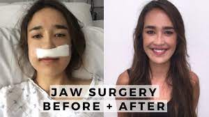 But which one is right for you? Underbite Correction Without Surgery Epic New Guide