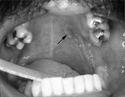 Image result for Erythroplakia roof of mouth