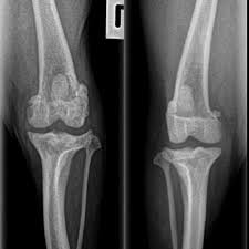 It's a highly malignant and aggressive tumour, of which 75% is found in the legs of large and giant breed dogs. 20 Causes Of Lameness Limping In Dogs Walkerville Vet