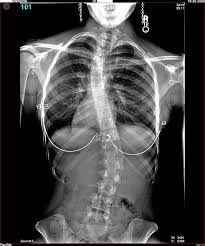 Pembentukan tulang dimulai dari matriks akan mengeluarkan kapur dan fosfor yang menyebabkan tulang menjadi keras. Soal Sistem Gerak Kelas Xi Sma Info Pendidikan Dan Biologi
