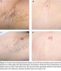 Other rare side effects include graying of treated hair or excessive hair growth around treated areas, particularly on darker skin. Ellipse Hair Removal The Clinical Proof Ellipse Lasers