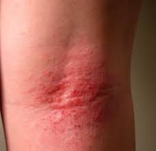Image result for Atopic eczema atopic dermatitis