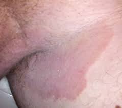 The infection can easily spread to other parts when the person scratches the affected skin and touches his groin. Tinea Cruris Wikipedia