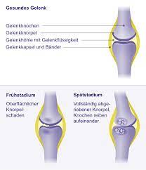 Die arthrose kann ebenfalls als folge einer anderen erkrankung, beispielsweise einer. Arthrose Gelenkerhaltende Therapie Gelenk Klinik De