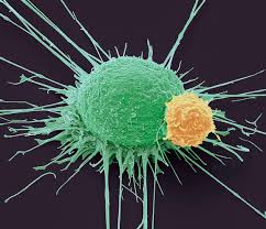Malignant pleural mesothelioma cancers treatment regimens. Journee Mondiale Contre Le Cancer Prevention Depistage Rapide Acces Aux Soins Actualite Parlement Europeen