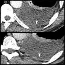 Maybe you would like to learn more about one of these? The Role Of Imaging In Malignant Pleural Mesothelioma An Update After The 2018 Bts Guidelines Sciencedirect