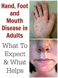 Visit the national agricultural library of the u.s. Hand Foot And Mouth Disease In Adults What To Expect Tots Family Parenting Kids Food Crafts Diy And Travel Hand Foot And Mouth Hand And Mouth Disease Mouth Sores