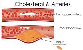 Penyakit degeneratif adalah penyakit yang mengiringi proses penuaan. Diet Amankah Bagi Penderita Penyakit Kronis Prosehat