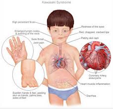 Not much can be done, in many. Pediatrics A Twitter 1 Kawasakidisease Is The Leading Cause Of Acquired Heart Disease In Infants And Young Children In Us It Causes Inflammation In The Blood Vessels And The Symptoms Can Be