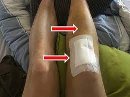 Finde Heraus Ob Dein Bluterguss Nach Knie Op Harmlos Ist Oder Nicht Knie Marathon Knie Op Reha Patienten Aufgepasst