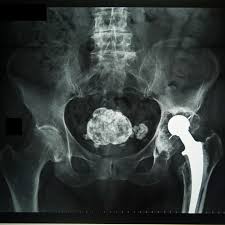 Abgeschwächtes atemgeräusch, hyper­ sonorer klopfschall, tachypnoe, tachy­ kardie. Radiologie Dtz Berlin Friedrichshain Konventionelles Rontgen