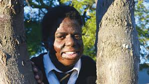 Safari's bravery: horrific burns and 18 operations