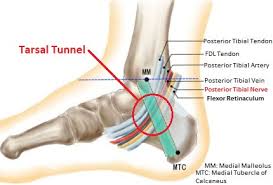 Tarsal Tunnel Syndrome Causes Symptoms Treatment
