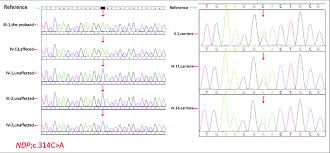 It is inherited in an. Detected Mutations In The Ndp Genes In Patients With Norrie Disease Download Scientific Diagram