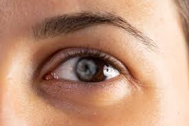 Image result for Coloboma