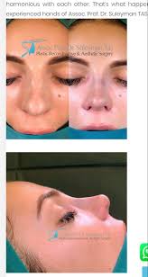 Pin By Zara Hiney On Nose In 2020 Nose Job Nose Surgery Rhinoplasty Nose Plastic Surgery