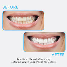You return to pines dental associates in about three weeks for fitting and care instructions. Teeth Whitening Snap Packs Go Smile