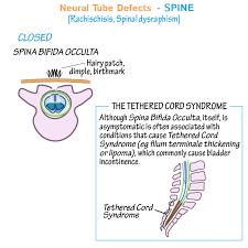 Image result for Dysraphism