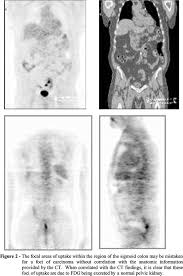 Ct scans can be misread or misinterpreted. Scielo Brasil Pet And Pet Ct Imaging For The Earliest Detection And Treatment Of Colorectal Carcinoma Pet And Pet Ct Imaging For The Earliest Detection And Treatment Of Colorectal Carcinoma