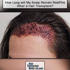 As a result it can take a while and even up to a month for redness to completely go away. How Long Will My Scalp Remain Red Pink After A Hair Transplant Hair Transplant Hair Loss Cure Hair Grafting