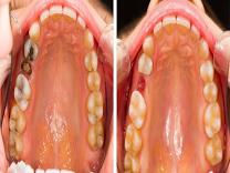 Post Extraction Care / Tooth Replacement Planning product image