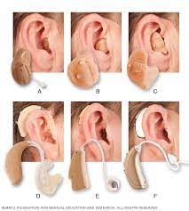 This is a custom hearing aid that is a hybrid between the bte and ite hearing aid types. Hearing Aid Styles Mayo Clinic