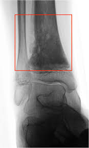 A tumor that has metastasized to bone is not made of bone cells. Distribution Patterns Of Foot And Ankle Tumors A University Tumor Institute Experience Springerlink