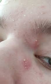 They differ from milia in appearance in that they are often a little larger and they are not white or yellowish in color. Need Help How To Get Rid Of Bumps Near Eye And Nose Seems To Just Get Worse Ever Day Acne