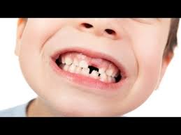 Si Tu Hijo Tiene Los Dientes Torcidos Tienes Que Ver Esto De Inmediato Youtube