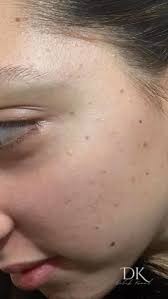 İz Bırakmadan Ben Alımı 🌸, #benalımı #yüzdebentedavisi  #izbırakmadanyüzbenialımı #cilt onarımı#ciltbakımıvegüzellik