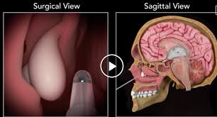 How to remove nasal polyps? Nose Polyp Removal Procedure Medical Videos