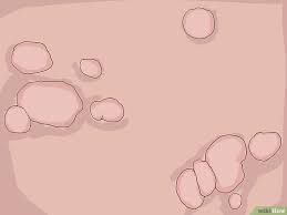 Most hpv infections go away on their own and don't cause any health problems. Hpv Virus Test Beim Mann Gardasil Erfahrungen Bewertungen Und Nebenwirkungen Sanego