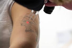 The tattoo removal program started in february 2012 as a collaborative partnership between the los angeles county sheriff's department medical services bureau and the inmate services bureau. Laser Tattoo Removal With Lasting Results For All Skin Types Laseraway