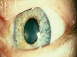 Image result for Pupillary Paralysis