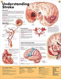 Understanding Stroke Chart 20x26 Medical Anatomy Neurology