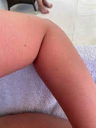 Ist Mein Sonnenbrand Schlimm Und Wann Geht Er Ungefahr Weg Gesundheit Und Medizin Gesundheit Urlaub
