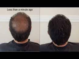 Hair Loss Concealers Or Fibers Is The New Way To Hide The Bald Areas And Offer A Nice Thick Hair In Less Th Hair Loss Concealer Hair Loss Hair Loss Concealers