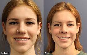 Once the jaw is realigned, plates and screws hold the bone in its new position. Orthognathic Surgery All Alaska Oral Craniofacial Surgery