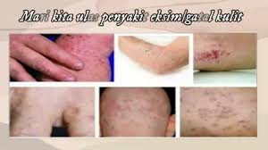 Cara Alami Mengatasi Gatal Gatal Berair Pada Kulit Di 2020 Kulit Kulit Kering Herbal Alami