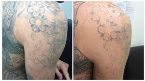 Step 3 begin your treatment with the uk's leading laser tattoo removal specialists. Lasering A Large Tattoo Or Several Original Laser Studio