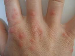 Pin On Bedbugs