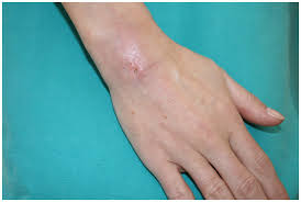 Image result for Hand Infection