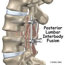 Posterior Lumbar Interbody Fusion Plif Video Spinal Fusion Spinal Fusion Surgery Spine Surgery