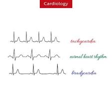 Sinustachykardie Ursachen Symptome Behandlung Medlexi De