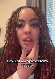 Melanie Roberson Apicoectomy Update
