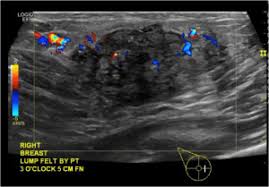 Image result for phlegmon of hand)