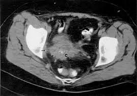 Pelvic floor muscles that are located wholly within the pelvis. Ct Atlas Glowm