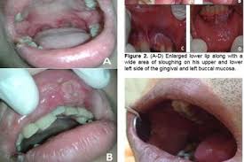Pernahkah anda mendengar istilah albothyl? Albothyl Bisa Sembuhkan Sariawan Di Mulut Berikut Penjelasan Ahlinya Semua Halaman Nakita