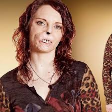 Brave woman who lost her nose and lips to meningitis sets sights