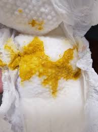 Your baby may have diarrhea if you see changes in the stool, such as more stools all of a sudden; Newborn Baby Diarrhea Pictures Newborn Baby